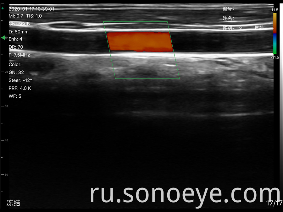 Super Width Linear Ultrasound Scanner for Breast Inspect